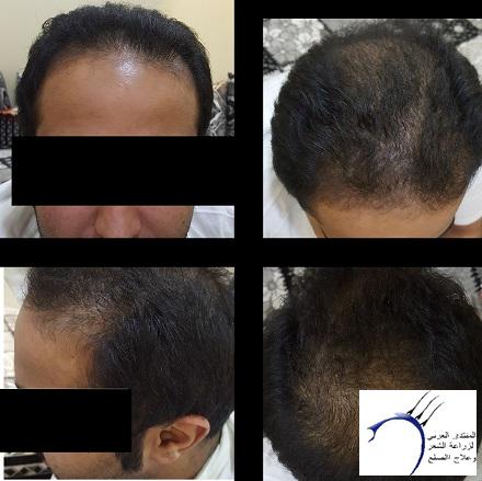 تجربة 3 اصدقاء لزراعة الشعر في تركيا في وقت واحد ايست اثيكا P_572qr6sh3
