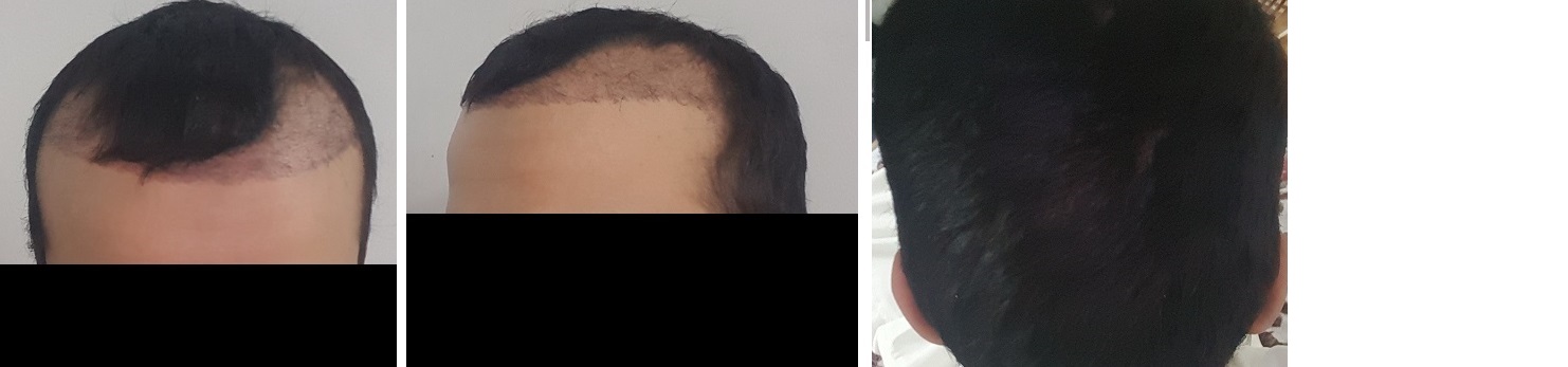 تجربة 3 اصدقاء لزراعة الشعر في تركيا في وقت واحد ايست اثيكا P_5734q3bo1