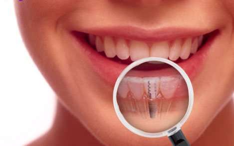 زراعة الاسنان و فوائدها  P_754ar3601